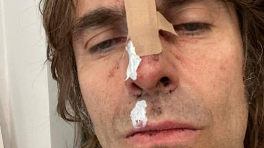 Liam Gallagher (Oasis) “se rompe la cara” tras caerse de un helicóptero
